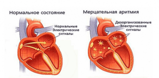 Что такое мерцательная аритмия