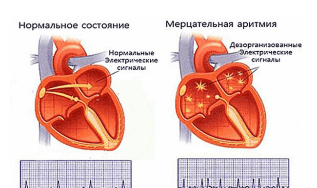 Что такое мерцательная аритмия